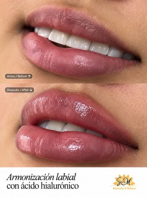 Publicación de SM Bienestar y Belleza sobre armonización labial con ácido hialurónico